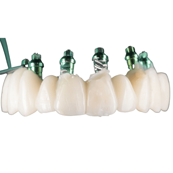 Implant Dentar Timișoara